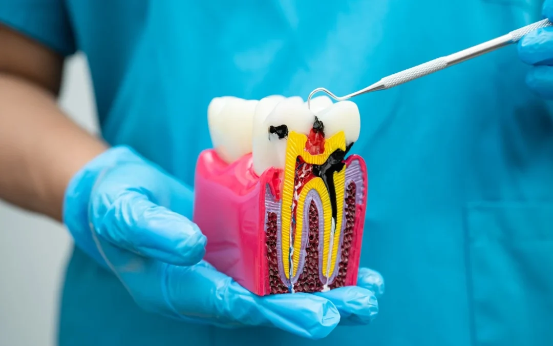Dental model showing tooth decay and root canal anatomy with dentist tool examining the cross-section.